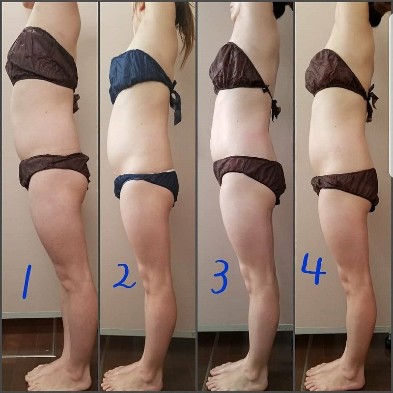 筋膜リリース お腹痩せ